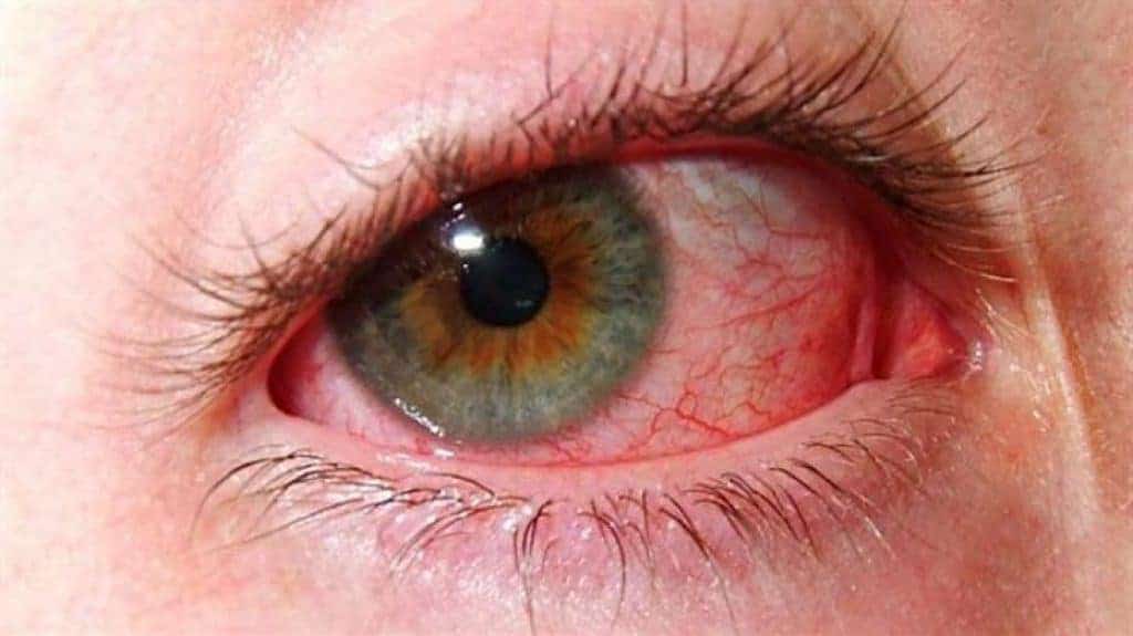 Yeux Rouge Sang 1 1024x575 | Québec Preppers Symptômes oculaires liés à des carences nutritionnelles en situation de crise