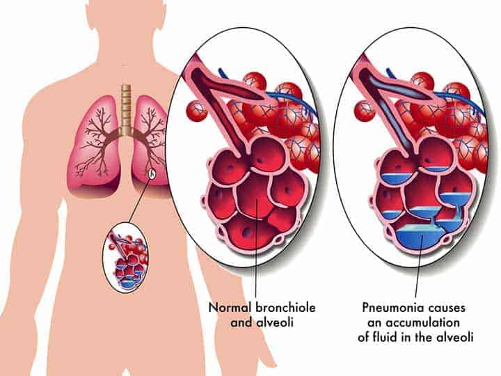 Pneumonia | Québec Preppers Illustration de la pneumonie